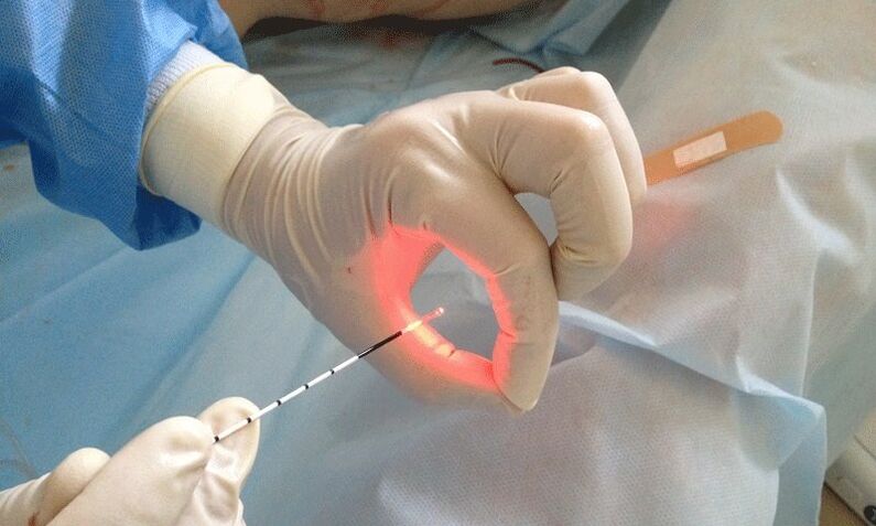 laserowe leczenie zapalenia prostaty